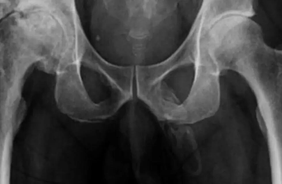 Tras realizarse una radiografía, el hombre descubrió que su pene se estaba convirtiendo en tejido óseo.