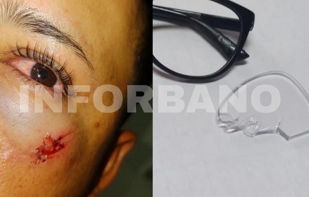El joven docente sufrió heridas graves en el ojo izquierdo debido a que uno de los cristales de sus anteojos estalló. - Gentileza