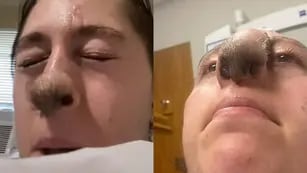 Recibió injertos de piel luego de ser atacada por un perro: ahora le crece pelo en la nariz