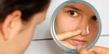 Cómo quitar el acné en 3 días de manera natural