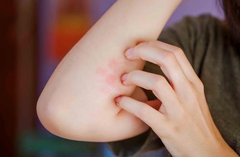 Dermatitis atópica en niños. (Freepik.com)