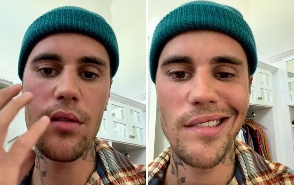 Justin Bieber sufre parálisis facial y grabó un video que preocupó a sus seguidores.