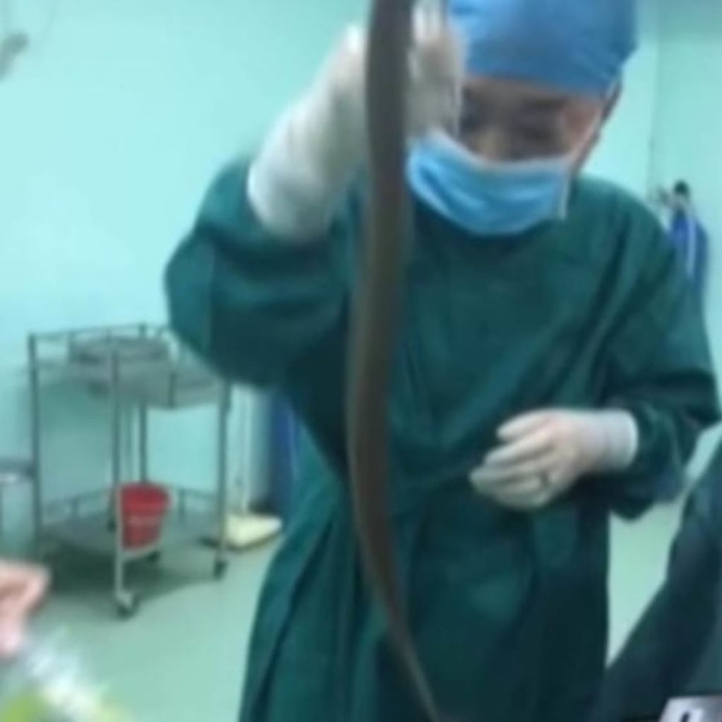 Los médico sacaron con vida a la anguila del estómago del paciente.