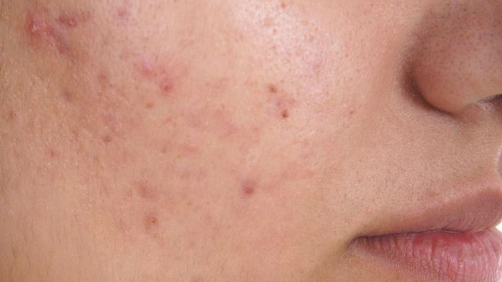 La mascarilla de canela y miel que es eficaz para eliminar el acné del rostro