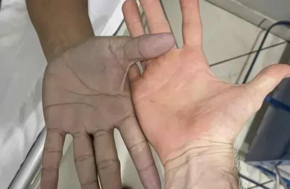 El médico que lo atendió escribió en Twitter: “Paciente joven acude por coloración azulada de manos, sin ninguna enfermedad de base. Gentileza: La Gaceta.