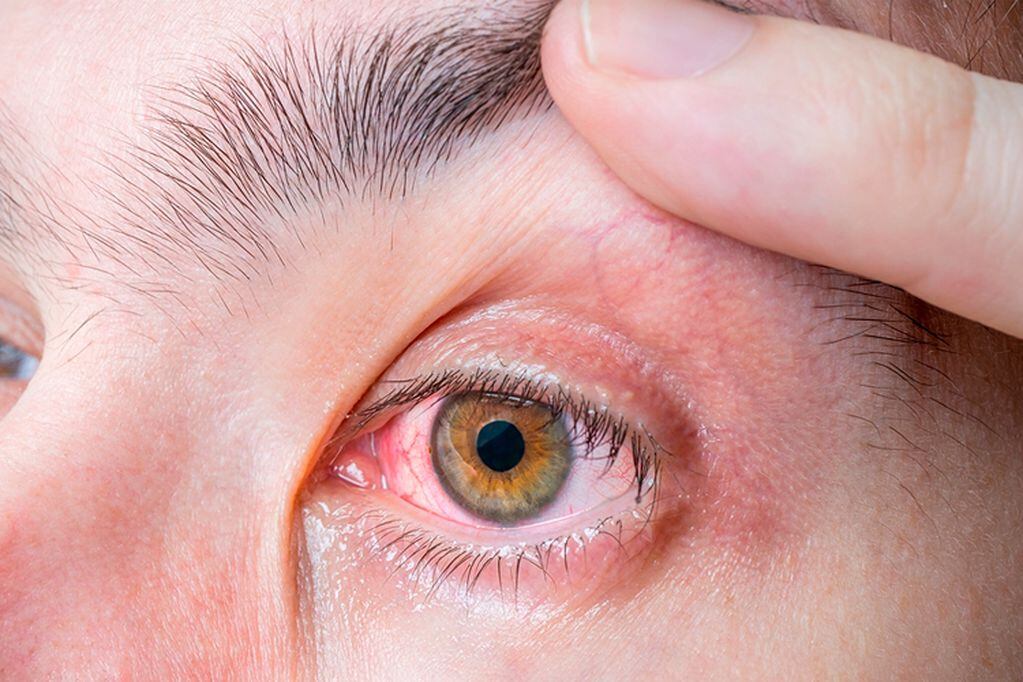 Los oftalmólogos adviertes que la conjuntivitis podría ser una señal de cuadro positivo de la enfermedad.