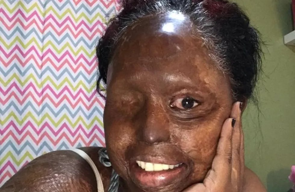 Esther ha sido sometida a 27 cirugías, incluyendo la extracción de su ojo izquierdo para que no perdiera su visión totalmente