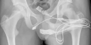 Un joven se introdujo un cable USB en el pene, comenzó a orinar sangre y fue operado de urgencia