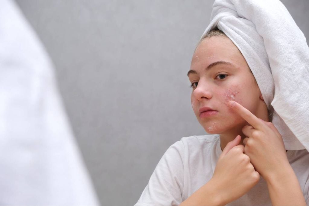 El método natural y efectivo para eliminar el acné
 (Shutterstock)