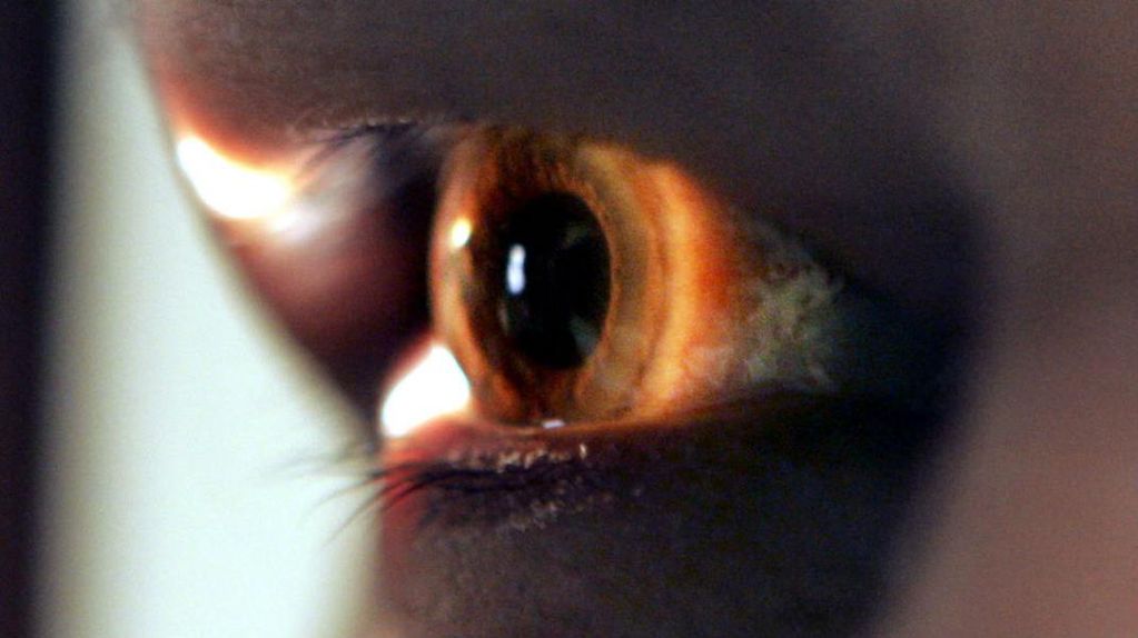 El glaucoma es un grupo de enfermedades de los ojos que pueden causar pérdida de visión y ceguera. Esto debido a que dañan el nervio ubicado en la parte de atrás del ojo, conocido como nervio óptico. 
Según la Organización Mundial de la Salud (OMS), el glaucoma es la segunda causa más común de ceguera en el planeta, luego de las cataratas. Sin embargo, dado que las cataratas pueden operarse, este se transforma en la primera causa de ceguera irreversible.
