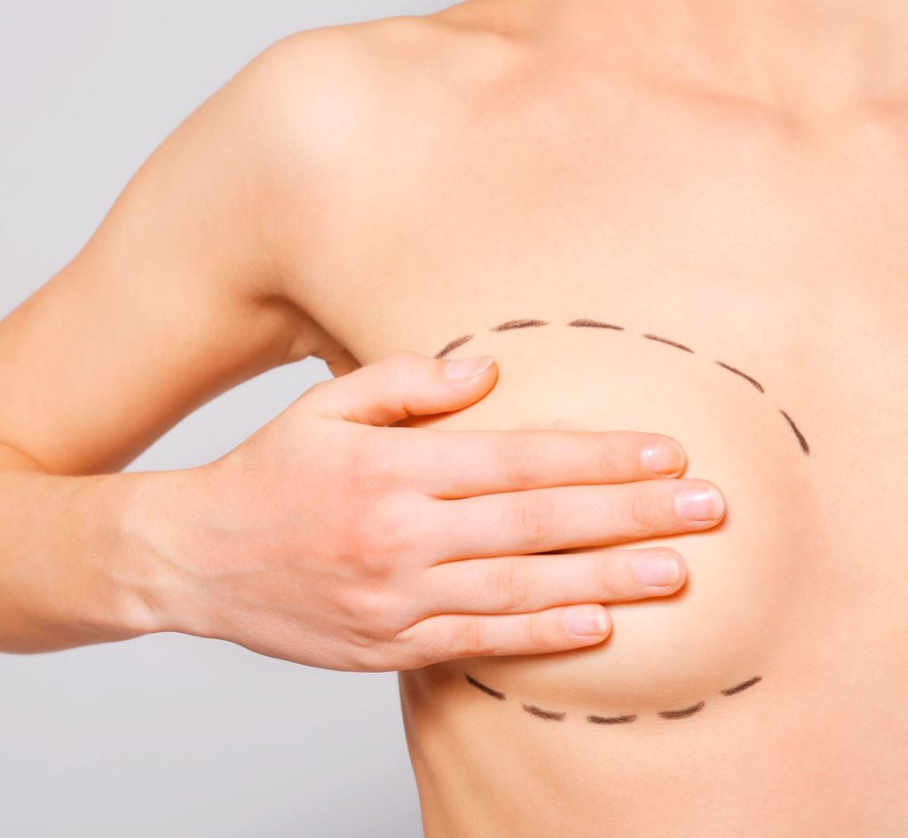 La cirugía de aumento mamario o mamoplastia de aumento consiste en mejorar tanto forma como volumen de la mama, con fines estéticos o reconstructivos, por medio de la inclusión de implantes de gel de silicona de alta cohesividad. 