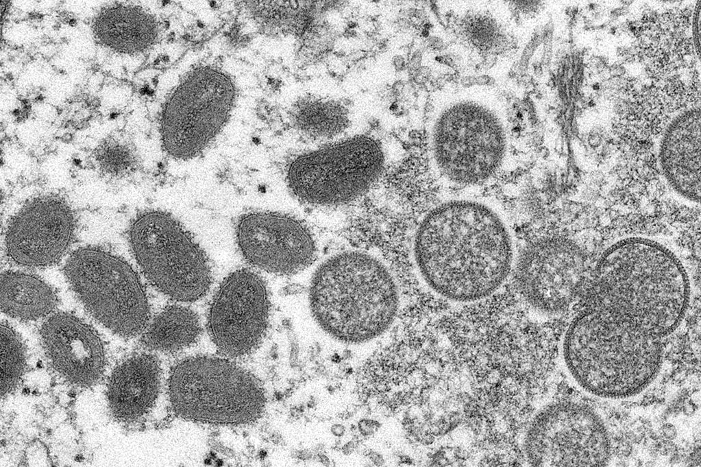 Esta imagen de microscopio electrónico de 2003 proporcionada por los Centros para el Control y la Prevención de Enfermedades muestra viriones maduros de viruela del mono de forma ovalada, a la izquierda, y viriones inmaduros esféricos, a la derecha, obtenidos de una muestra de piel humana asociada con la pradera de 2003 brote de perro  (AP) 
