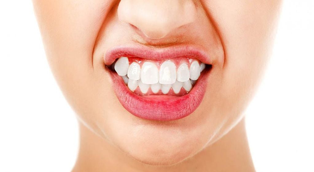 El hábito de apretar los dientes puede producir desgastes de piezas dentarias. / Sanatorio Allende