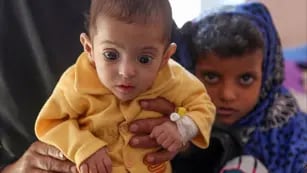 Niños desnutridos en Yemen