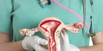 Cáncer de ovario