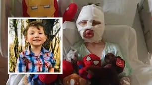Un nene de 6 años sufrió graves quemaduras tras el ataque de otro chico