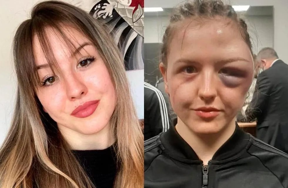 La boxeadora alemana Cheyenne Hanson compartió una foto del antes y después de su rostro tas la pelea. Foto: Twitter.