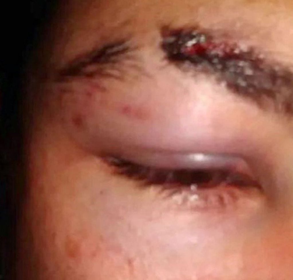 En las redes sociales, los amigos del joven golpeado por un grupo de rugbiers compartieron fotos de cómo quedó el joven de 25 años tras la golpiza. Foto: Clarín