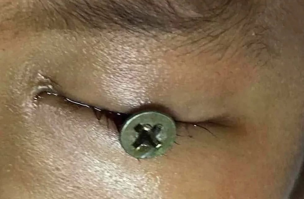 Un nene de 3 años sufrió una terrible lesión ocular cuando su papá cortaba el pasto y un tornillo se engancó en la máquina, voló y se clavó en su ojo.