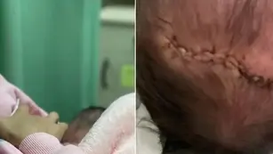 Bebé recién nacida cayó de cabeza tras el parto
