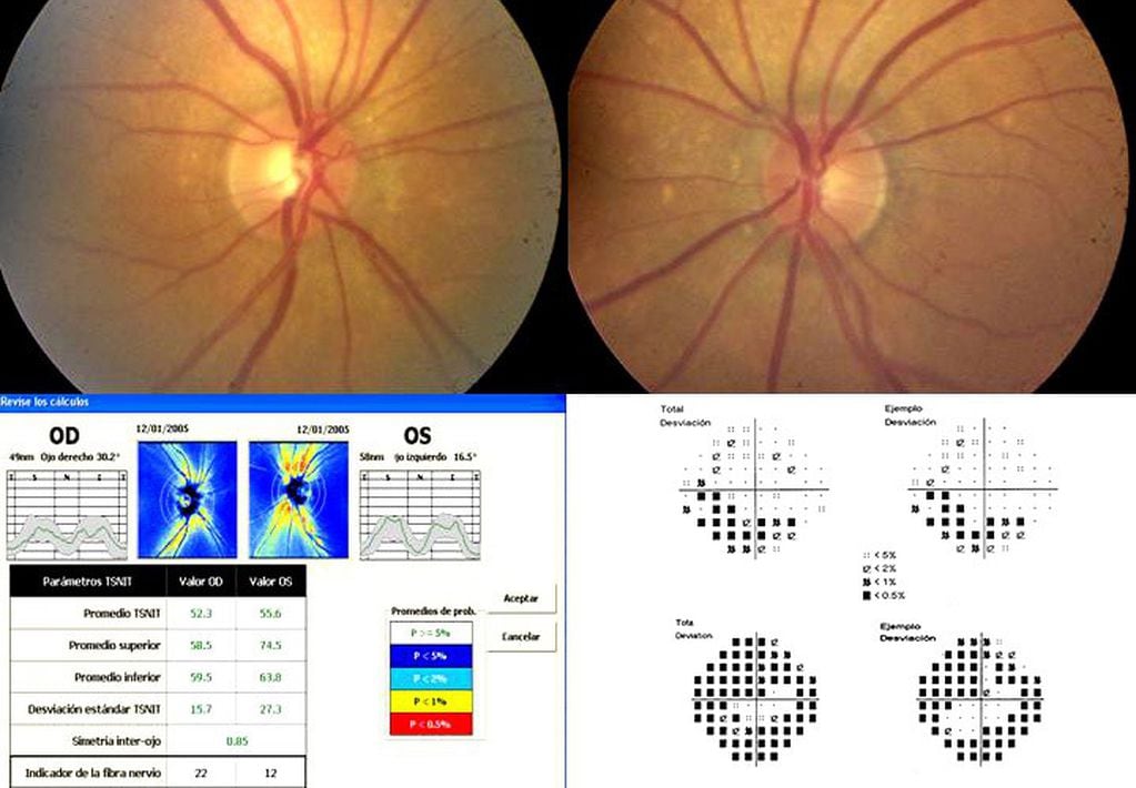 La detección precoz del glaucoma es fundamental. 