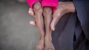 Un niño con desnutrición
