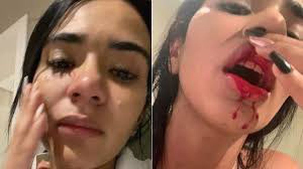 Daniela Cortés publicó un video de las lesiones que le causó Villa en redes sociales.