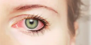 La conjuntivitis es una de las afecciones del ojo más frecuentes y tratables en el mundo. (Sanatorio Allende)