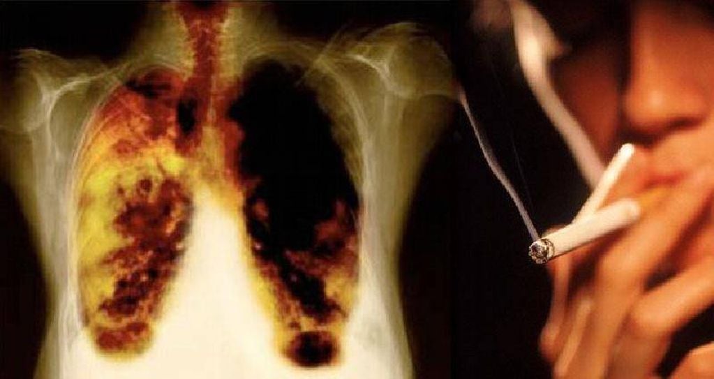 Más de dos millones de argentinos sufren riesgo de EPOC.
Las enfermedades respiratorias representan el 14% de todas las muertes en el país y están asociadas al humo del tabaco, la contaminación del aire, la exposición a alérgenos y la inhalación de polvo y productos químicos en el medio laboral.
