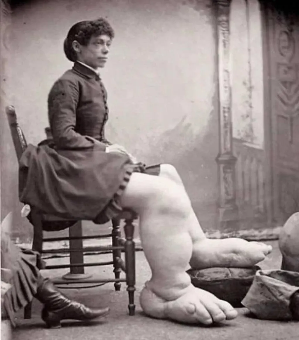 Fanny Mills sufría una enfermedad rara que deformaba sus extremidades inferiores. Murió a los 39 años. Gentileza.